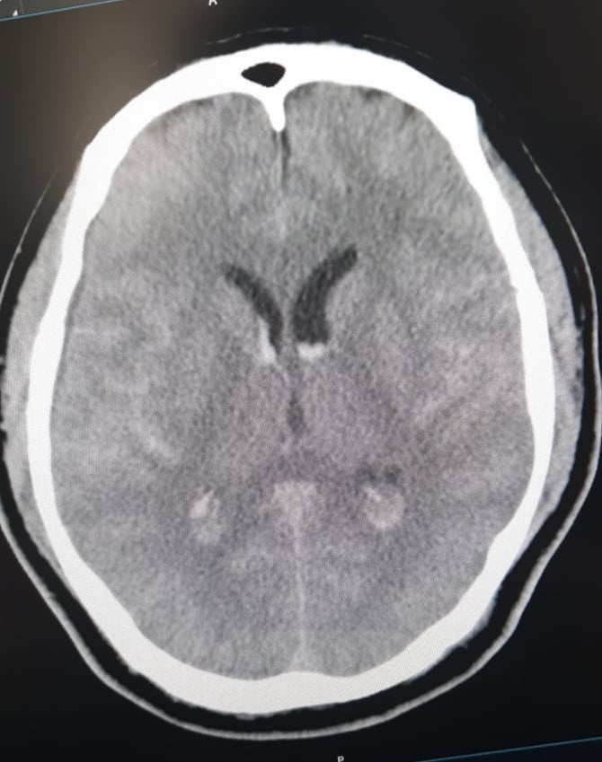 bieu hien benh nhan dot quy anh 1