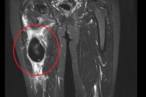 Nguoi phu nu co khoi u than kinh lon o mong hinh anh