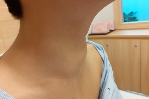 Sai lam khien benh nhi mac ung thu tuyen giap nguy kich hinh anh