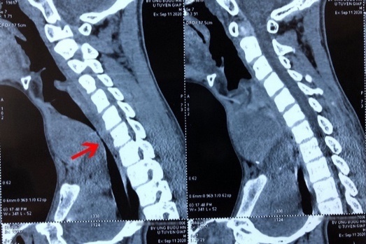 dieu tri ung thu di can anh 1