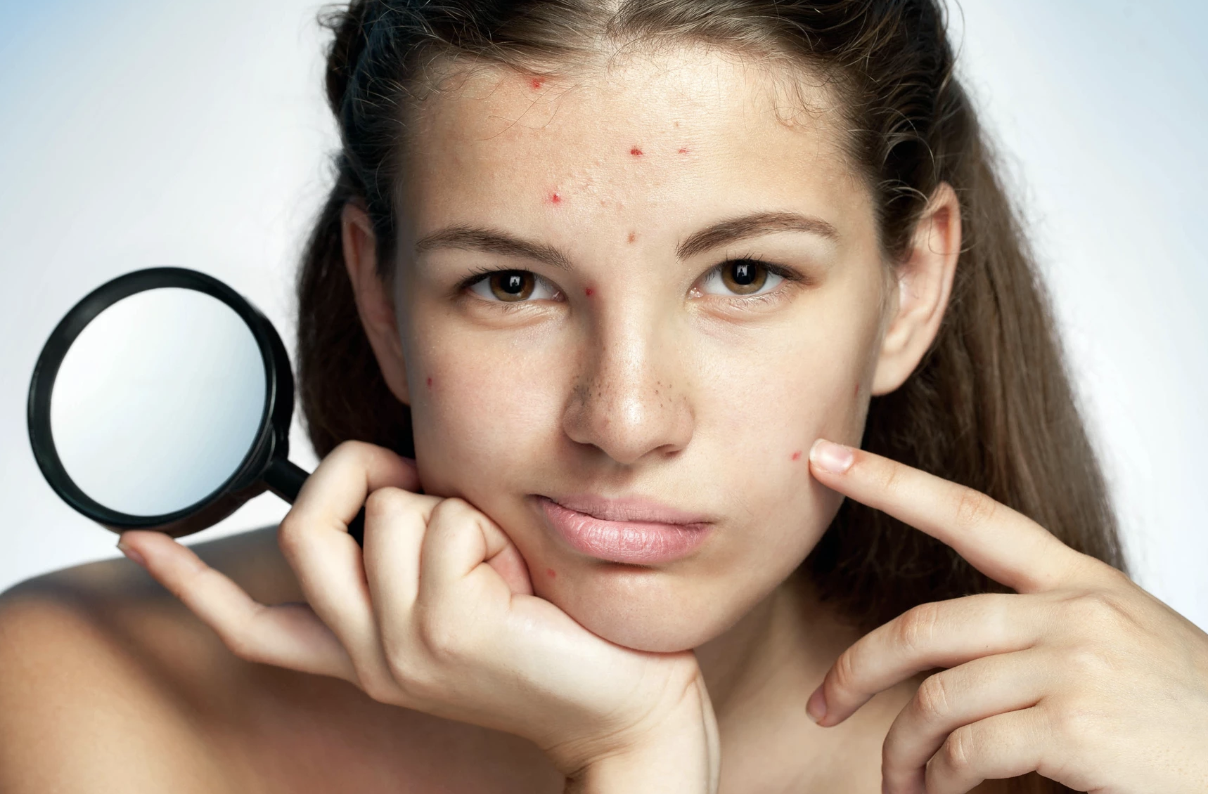 cach tri mun trung ca anh 1