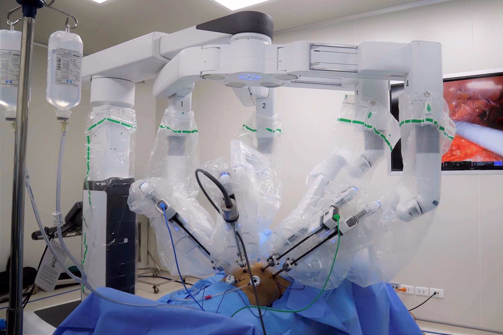 Nguoi phu nu duoc phau thuat ung thu bang robot hien dai nhat the gioi hinh anh