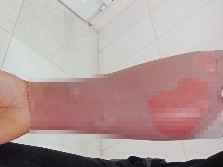 Nguoi dan ong bi loet da sau khi tam bang la cay hinh anh