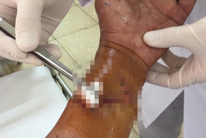 Nguoi dan ong bi may cua go cat vao cang tay hinh anh