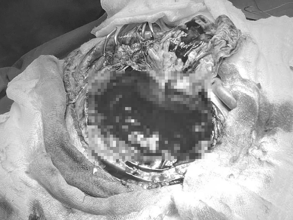 Cuu benh nhan vo mach mau nao hinh anh