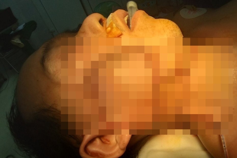 khối u trên mặt  ảnh 1 khoi u tren mat anh 1