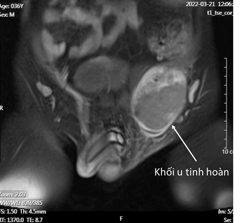 ung thu do an tinh hoan anh 1