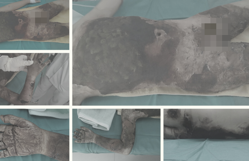 benh nhi dap thuoc bong anh 1