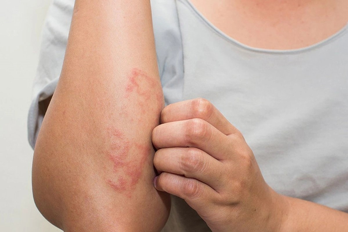 Cach phong benh ve da trong nhung ngay nang nong hinh anh