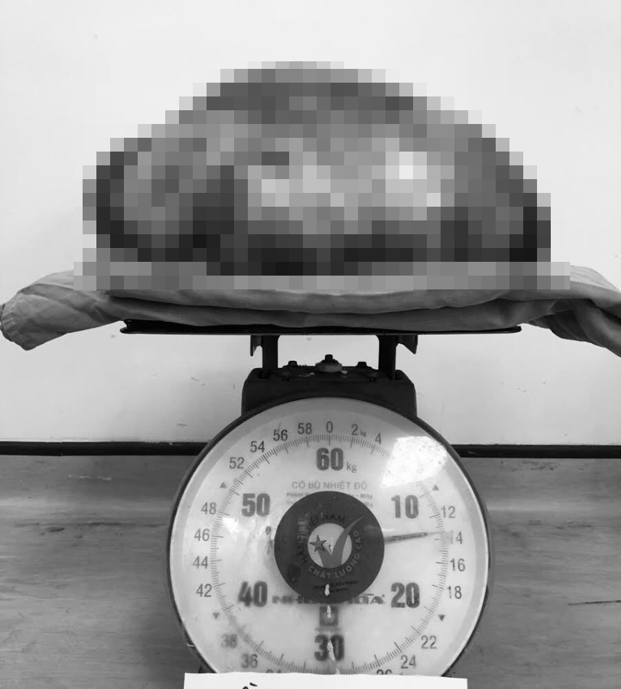 khoi u khong lo trong bung nguoi phu nu anh 1