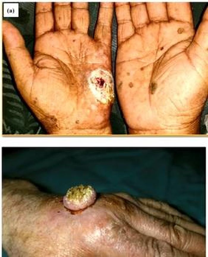 phat hien ung thu da anh 1