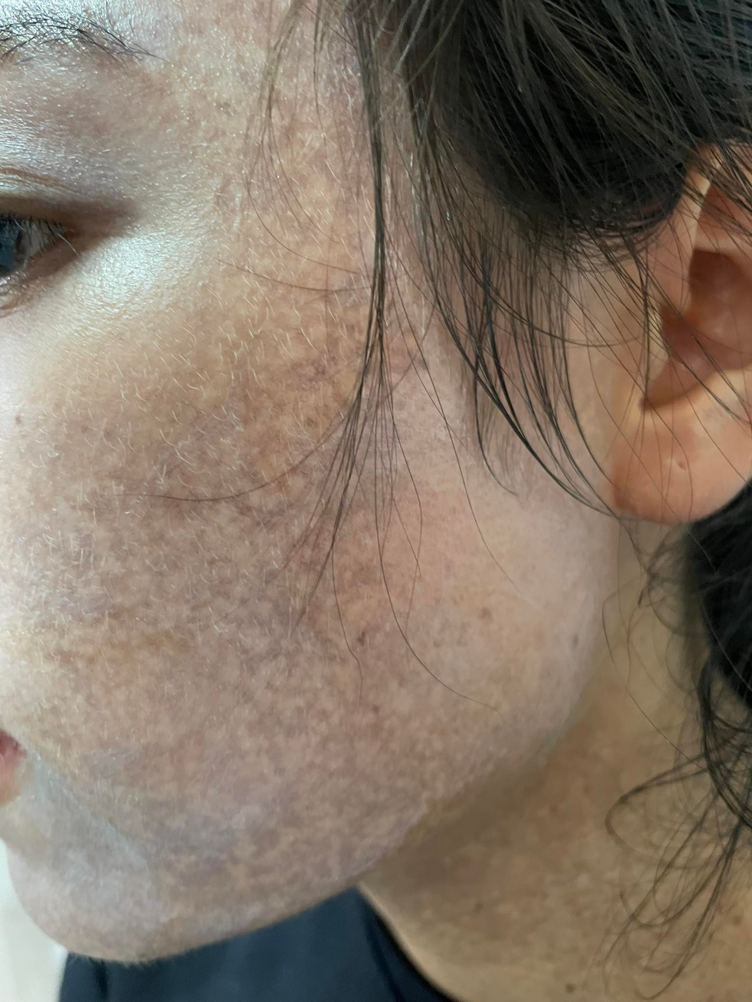nhận hậu quả do peel da ảnh 1 nhan hau qua do peel da anh 1
