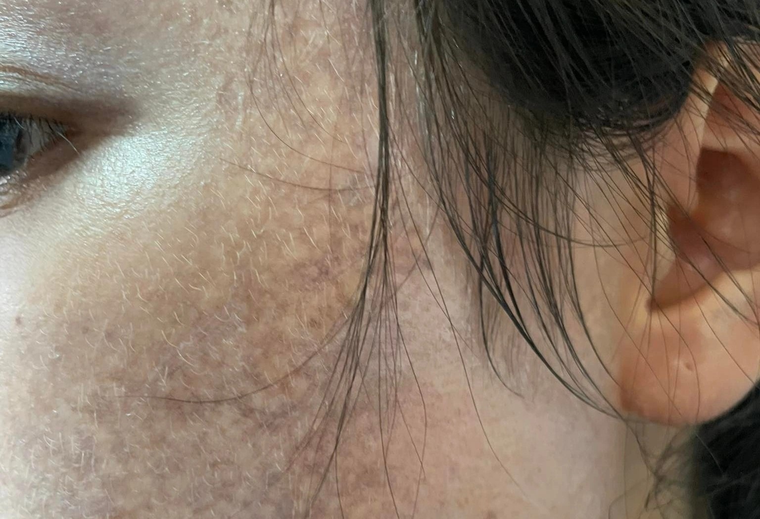 Mat chay den vi lan kim, lot da bang hoa chat vo toi va hinh anh