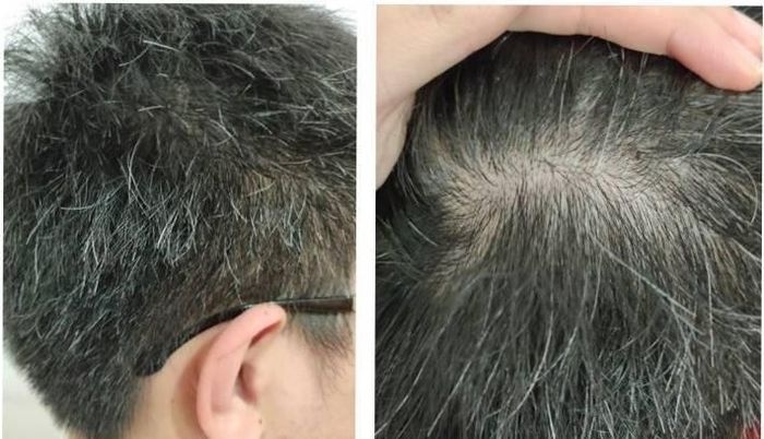 nguyen nhan toc bac som anh 1