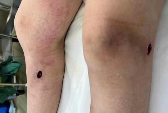 bien chung do tiem filler anh 1