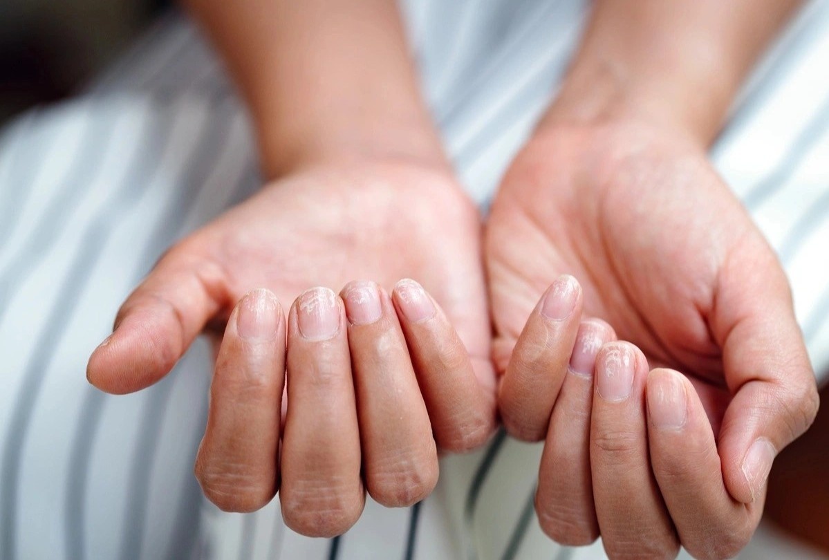 Nhung bieu hien cua tinh trang thieu sat hinh anh