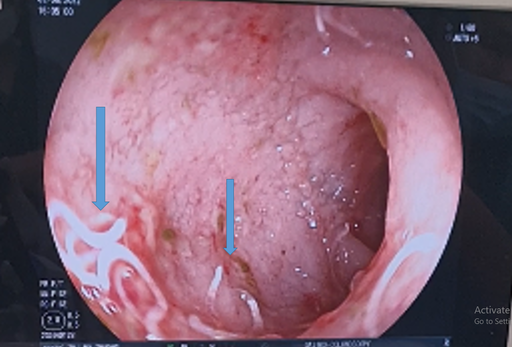 xuat huyet tieu hoa vi nhiem giun anh 1