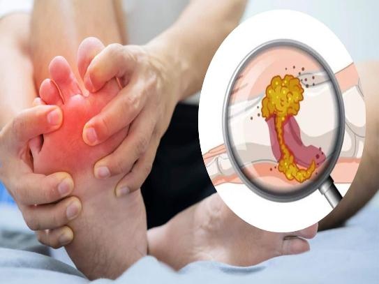 thuc pham giam axit uric anh 1