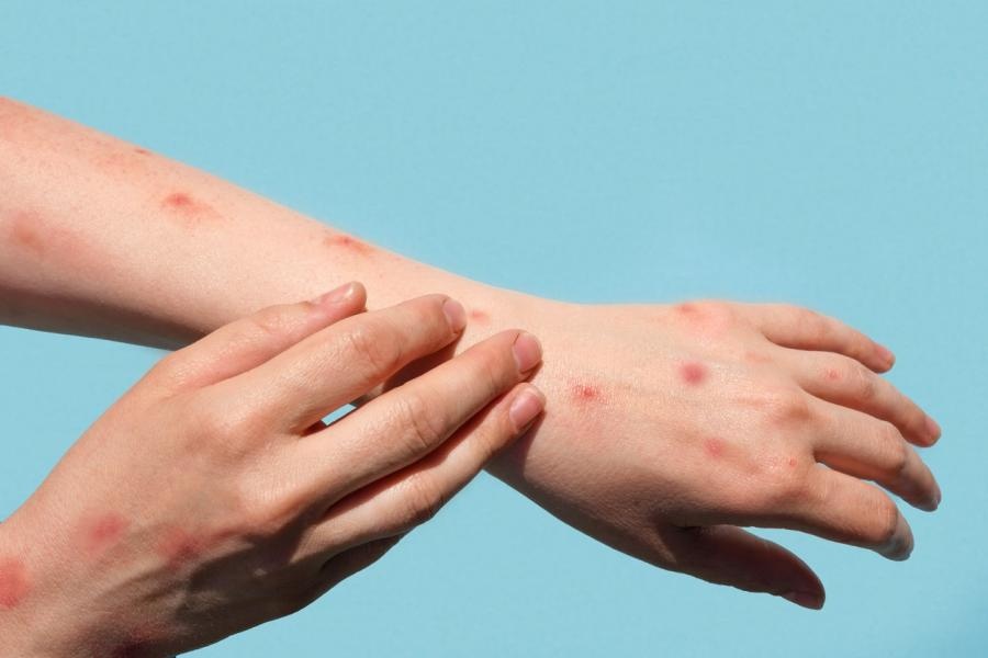 phát ban đậu mùa khỉ ảnh 1 phat ban dau mua khi anh 1
