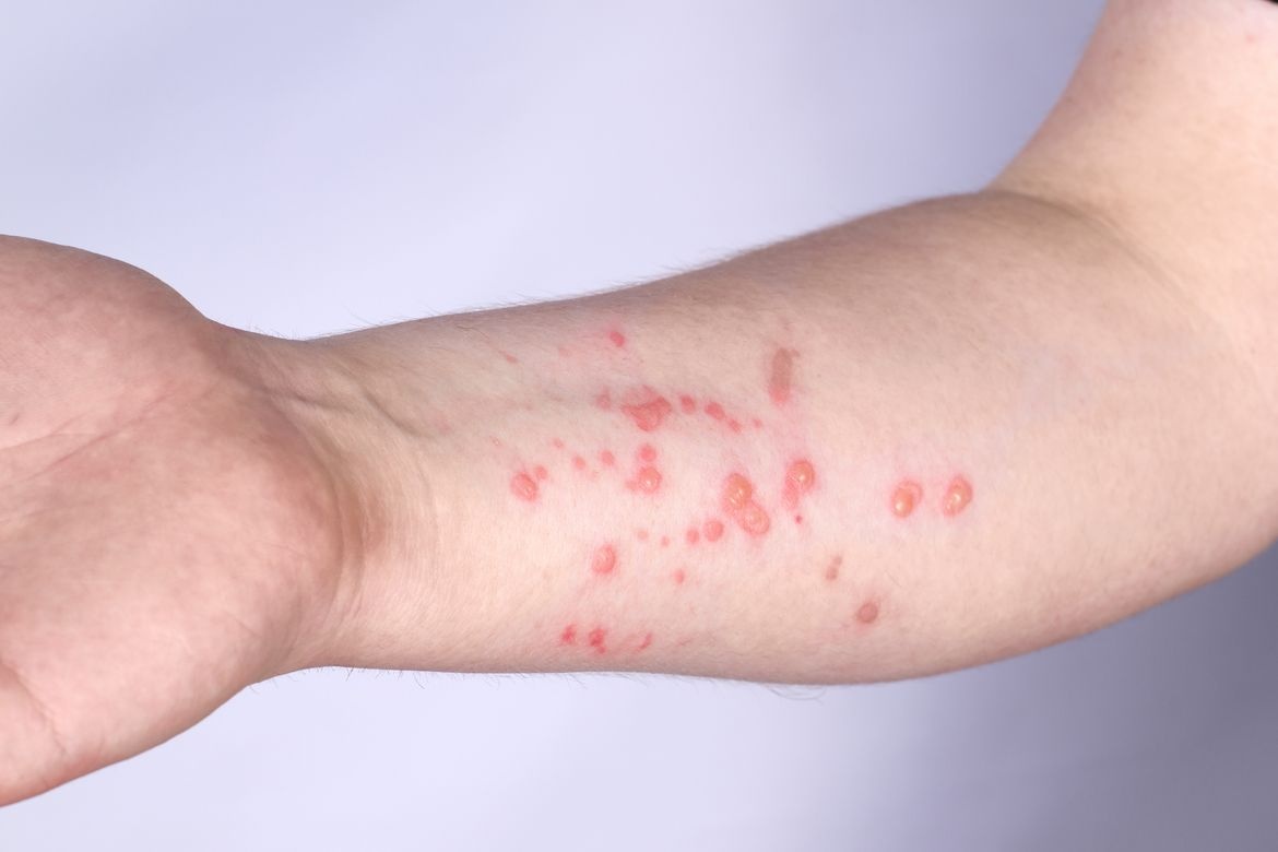 phát ban đậu mùa khỉ ảnh 2 phat ban dau mua khi anh 2