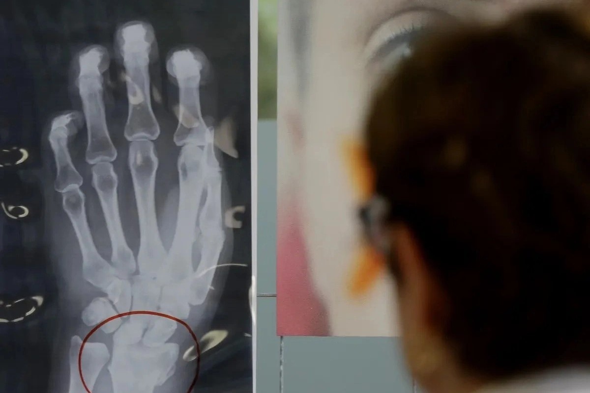 Can benh tham lang gay tan phe hinh anh