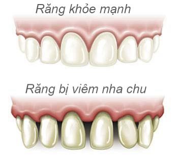 viem nuou gay mat rang anh 1