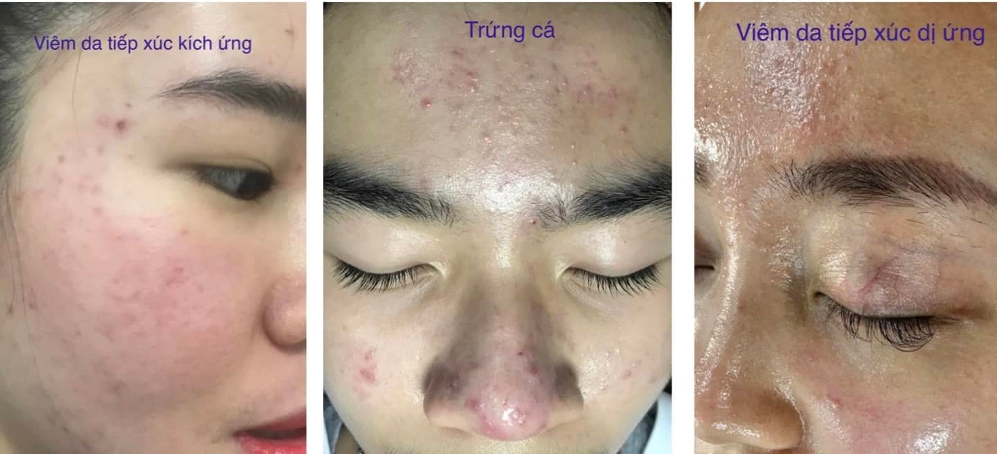 phân biệt mụn bất thường ảnh 1 phan biet mun bat thuong anh 1