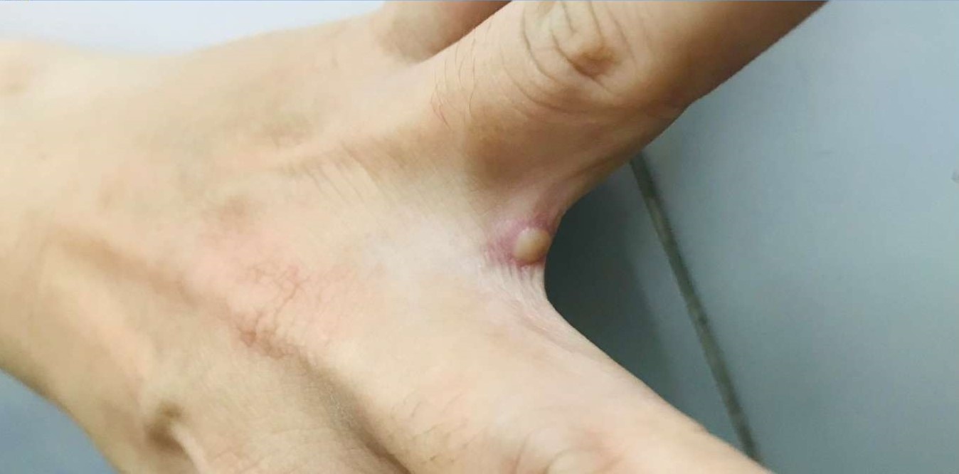 dich benh dau mua khi anh 2