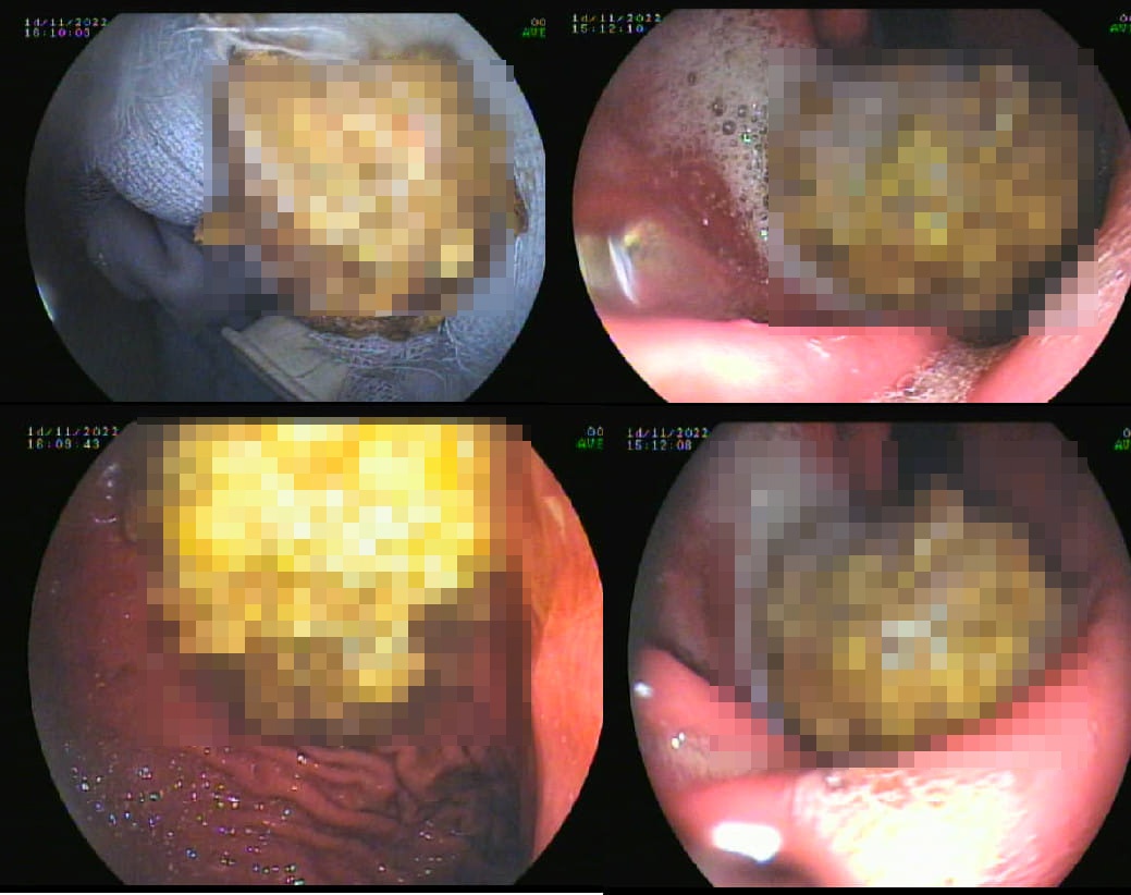 tac ruot do hong gion anh 1