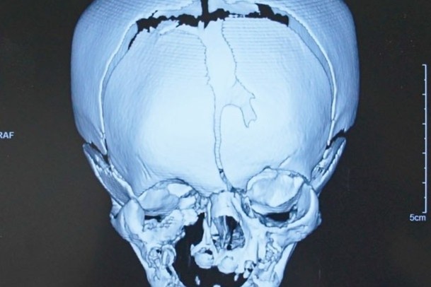 Be trai 17 ngay tuoi co khe ho o so gay bien dang nua mat hinh anh