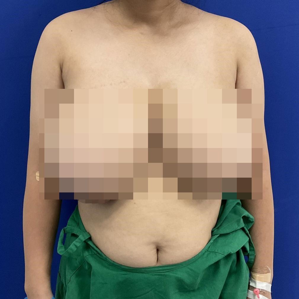 thu nho bau nguc anh 1