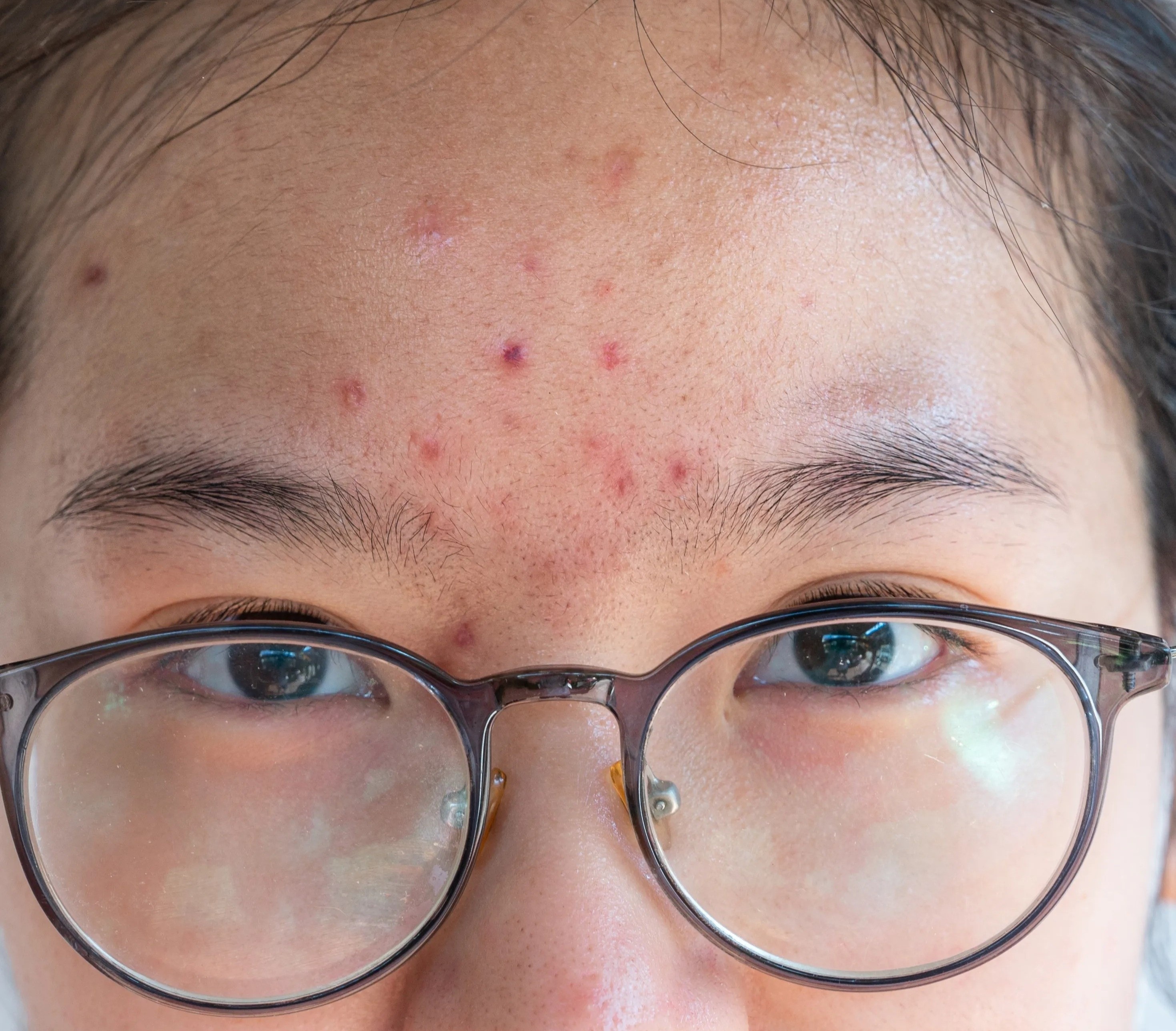 cách trị mụn trứng cá ảnh 2 cach tri mun trung ca anh 2
