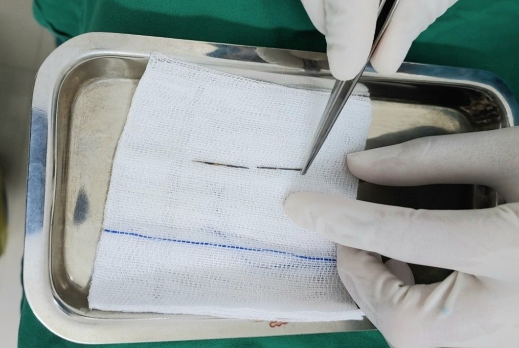 Be trai 4 tuoi duoc tim thay chiec kim khau trong phoi hinh anh