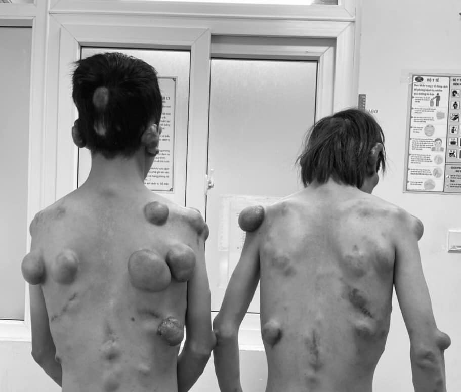 song sinh u khắp người ảnh 1 song sinh u khap nguoi anh 1