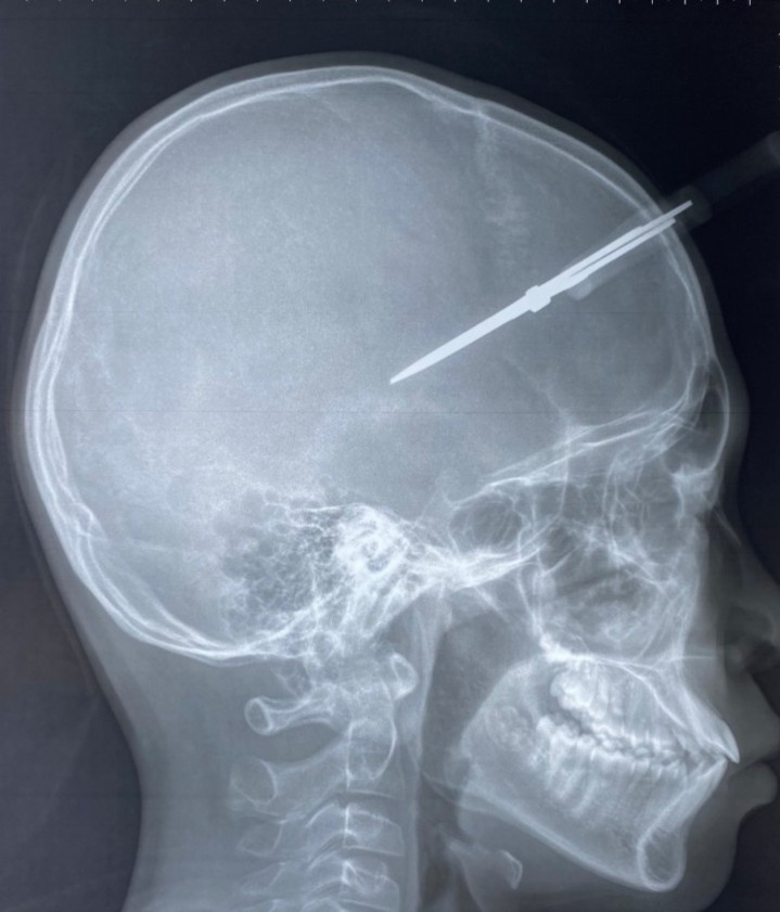 keo cam vao so anh 1