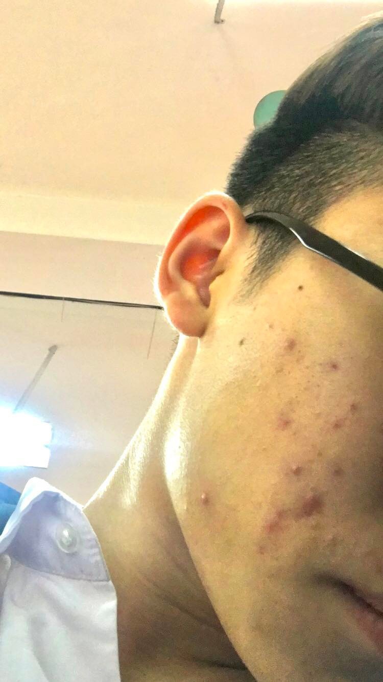 chăm sóc da mụn ảnh 3 cham soc da mun anh 3