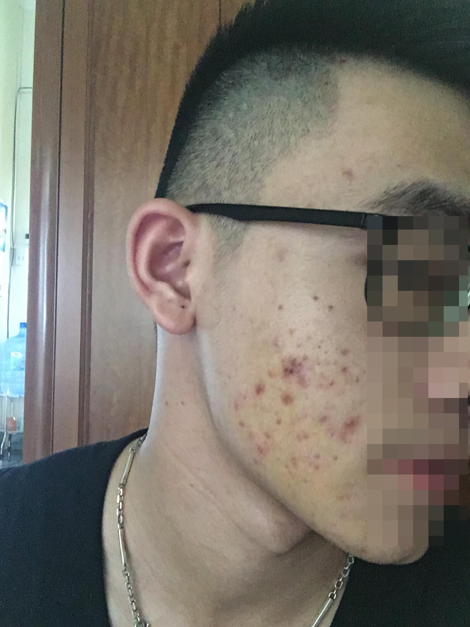 chăm sóc da mụn ảnh 4 cham soc da mun anh 4