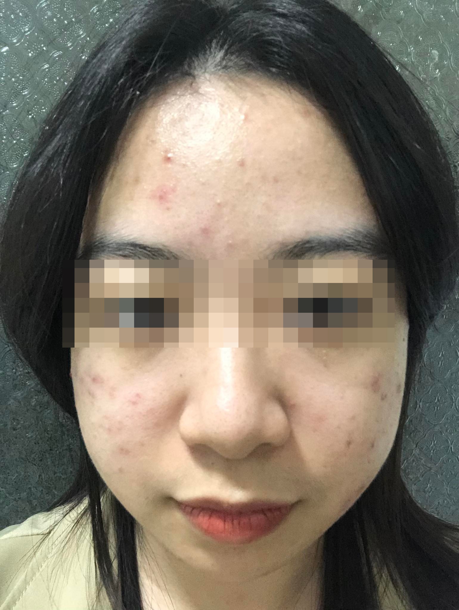 chăm sóc da mụn ảnh 2 cham soc da mun anh 2