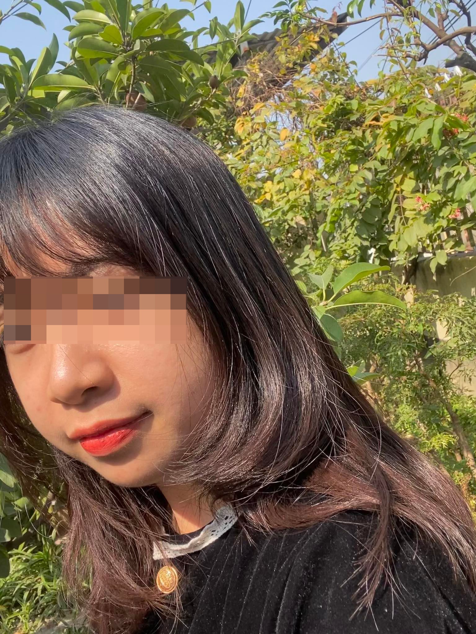 chăm sóc da mụn ảnh 1 cham soc da mun anh 1