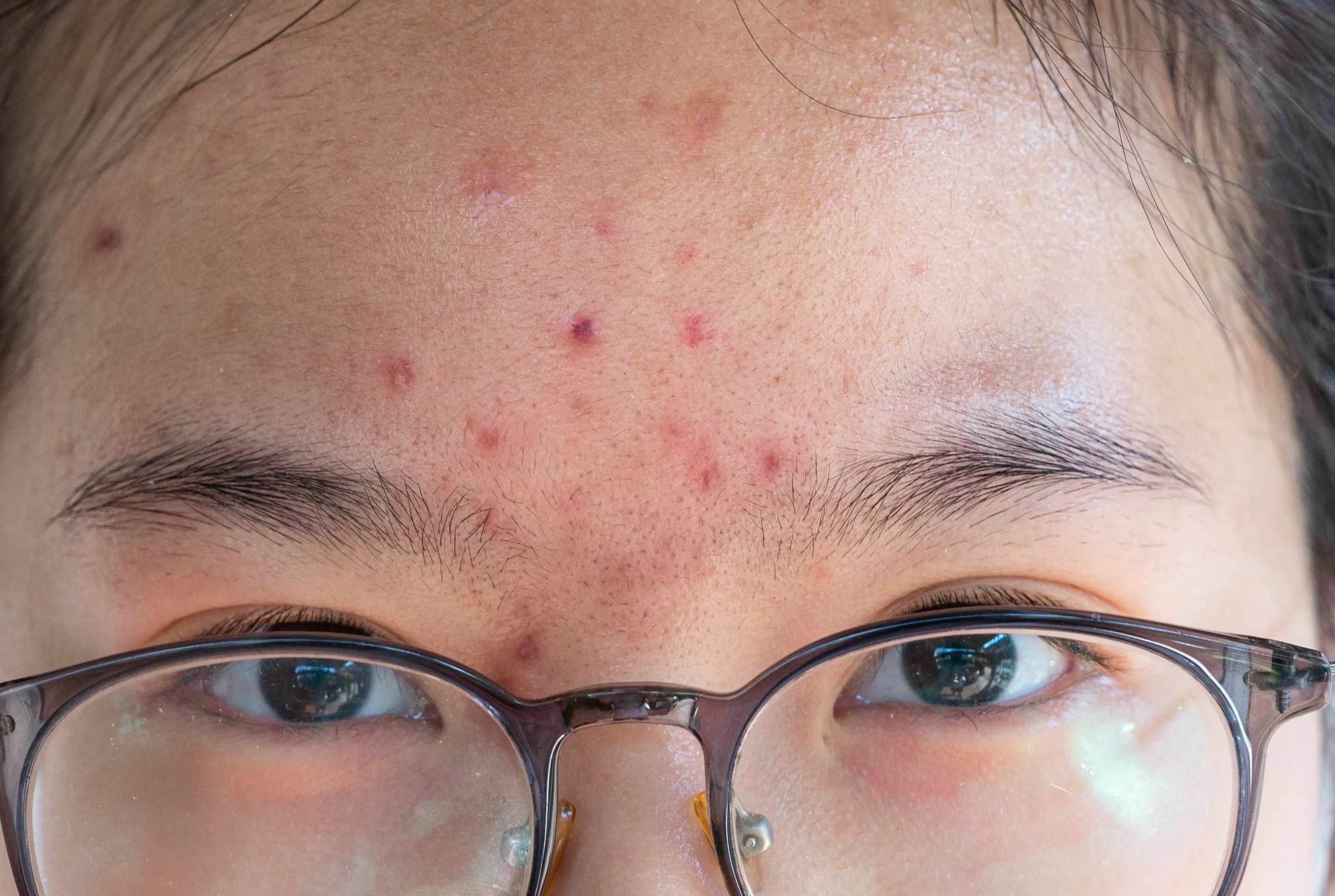 Nghich ly cham da cua nguoi tre hinh anh