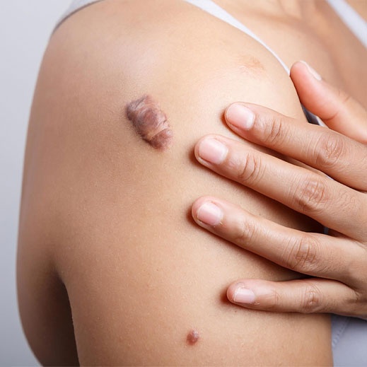 tri seo bang laser anh 2