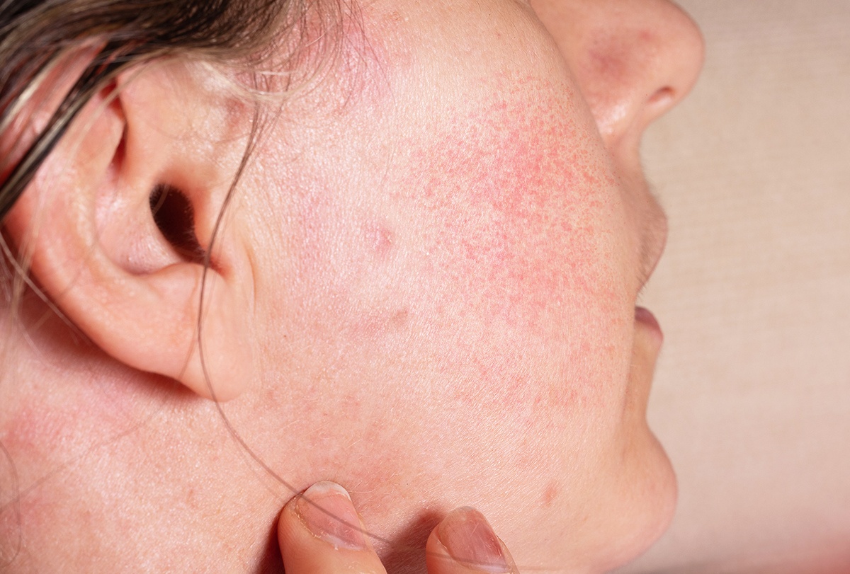 Nhung nguyen nhan gay ngua da mat hinh anh