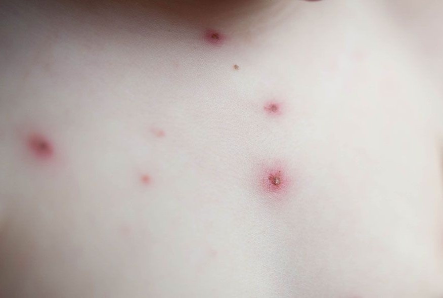 dich benh thuy dau anh 2