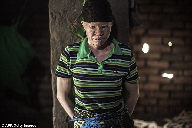 Cô Dorothy Mausen, 22 tuổi, là người bạch tạng sống ở Malawi. Chính quyền Malawai đã ra lệnh cảnh sát bắn hạ bất cứ người nào tấn công những người bạch tạng. 