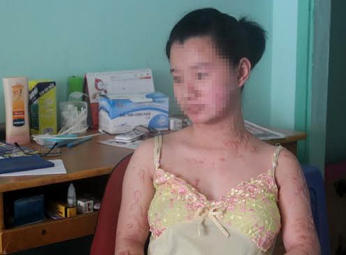 Cuoc song tam toi cua 2 co gai bi tat axit o Sai Gon hinh anh