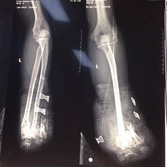 nhap vien vi danh nhau ngay tet anh 2