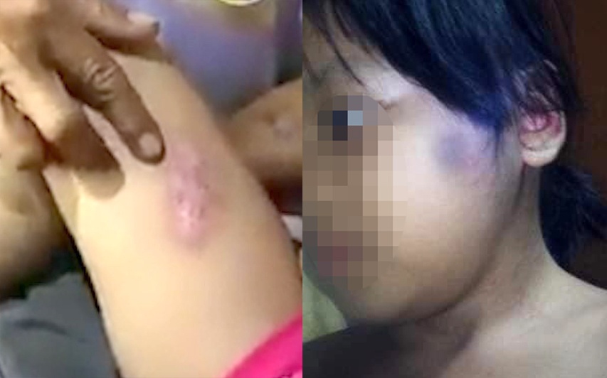 Be gai 6 tuoi bi cham thuoc la vao nguoi hinh anh