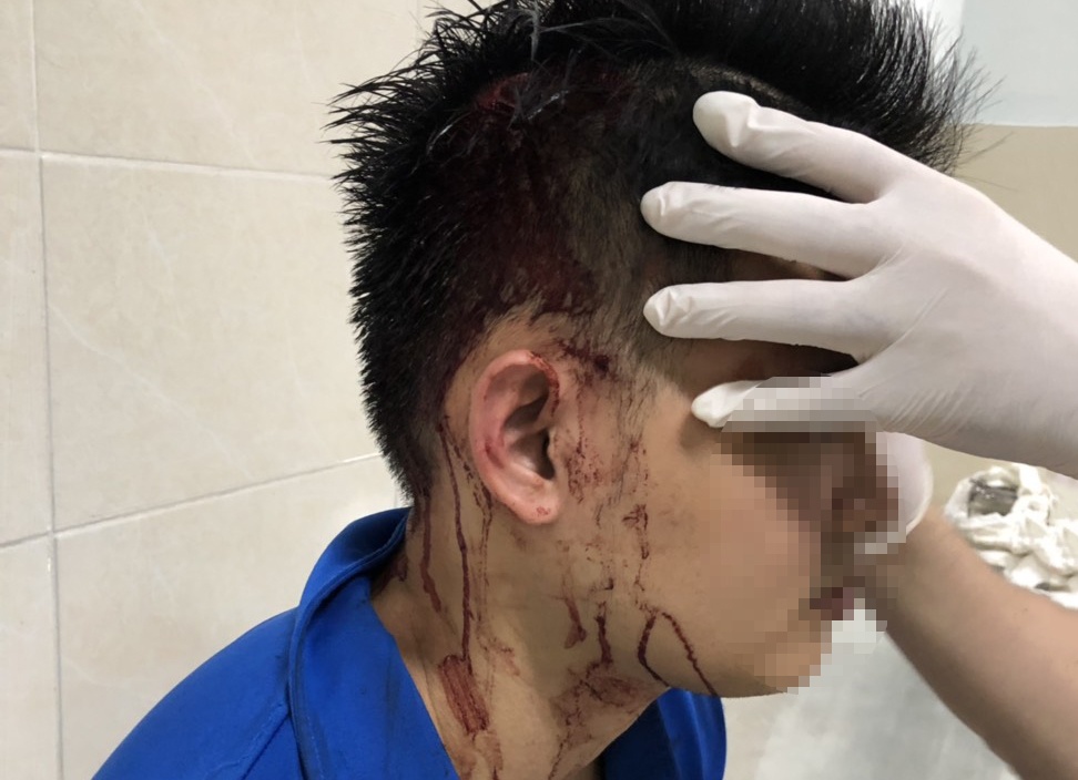 thanh niên bị bắn đạn bi vào đầu ảnh 1 thanh nien bi ban dan bi vao dau anh 1