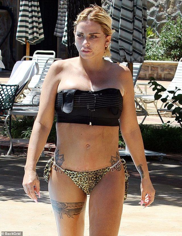 Katie Price phẫu thuật hỏng ảnh 2 Katie Price phau thuat hong anh 2