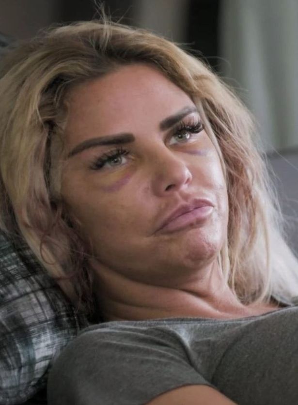 Katie Price phẫu thuật ảnh 1 Katie Price phau thuat anh 1